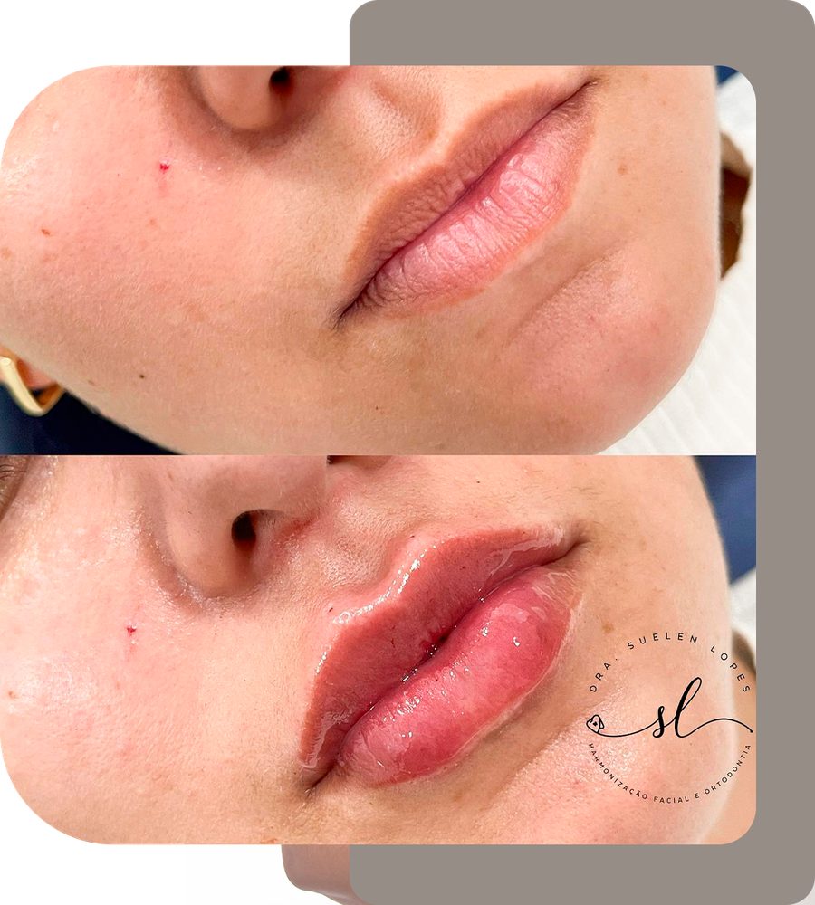 Resultado de harmonização facial de uma paciente