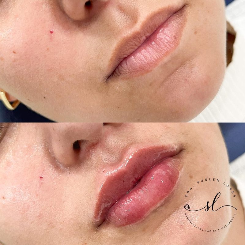 Resultado de harmonização facial de uma paciente