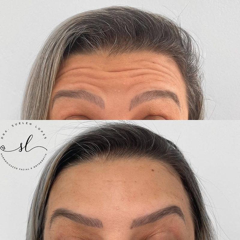 Resultado de harmonização facial de uma paciente