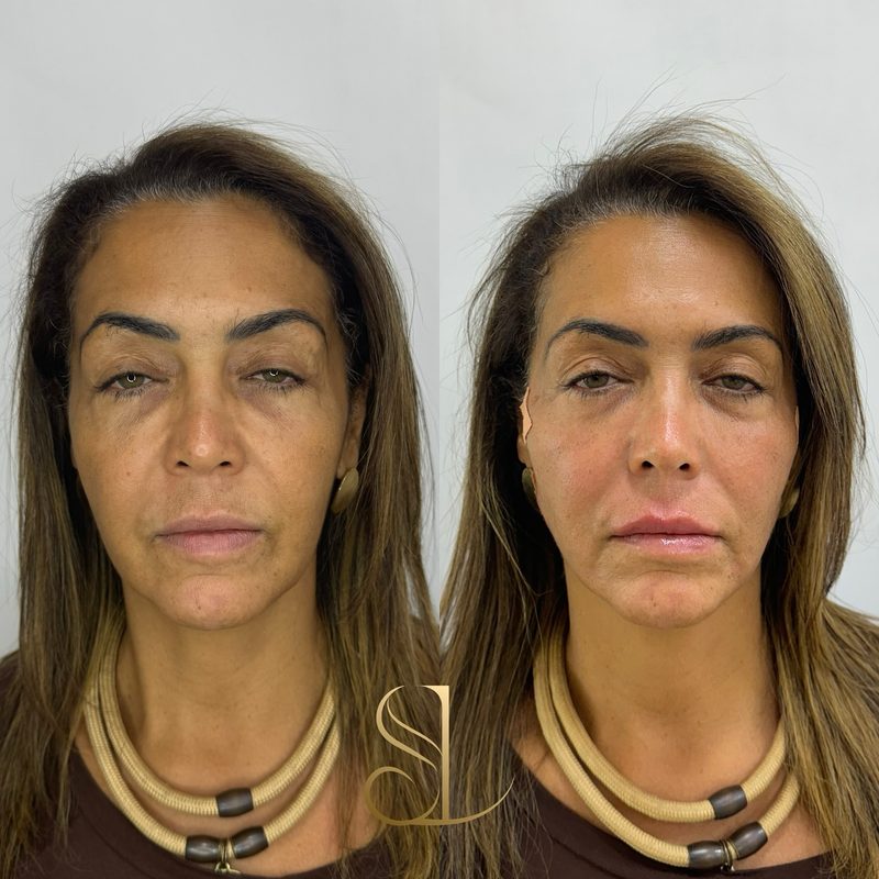 Resultado de harmonização facial de uma paciente