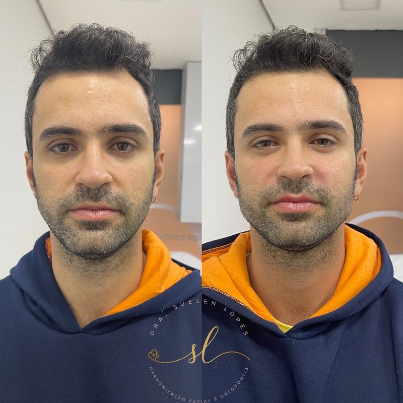 Resultado de harmonização facial de uma paciente