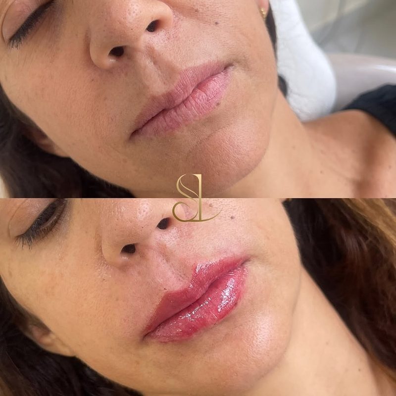 Resultado de harmonização facial de uma paciente