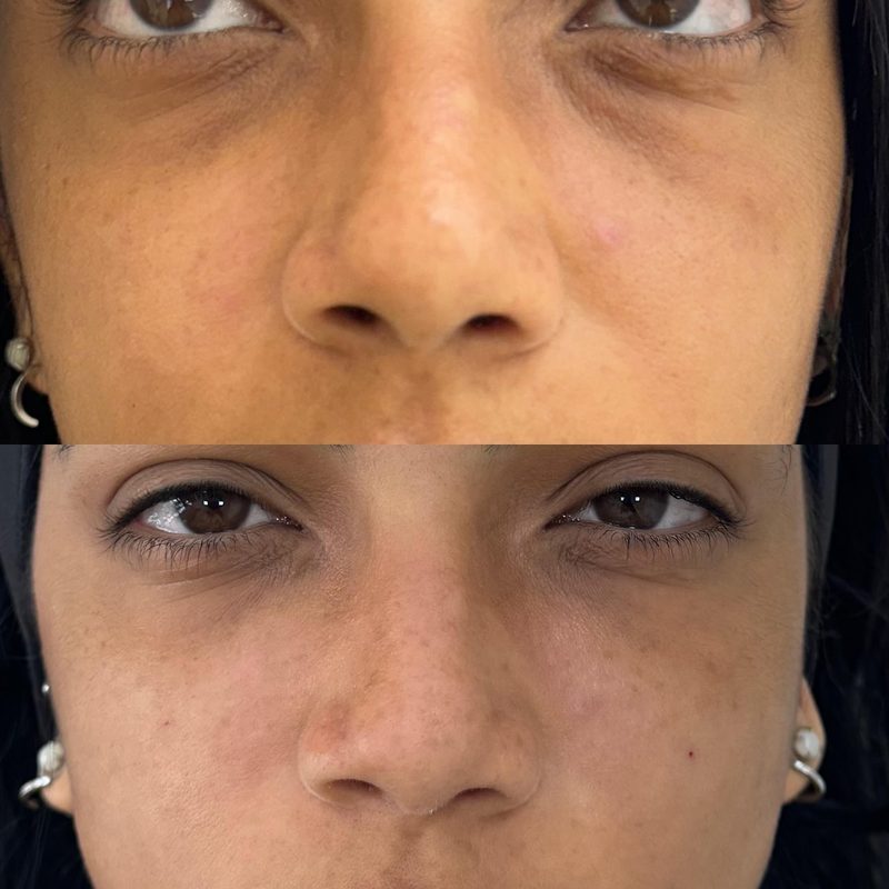 Resultado de harmonização facial de uma paciente