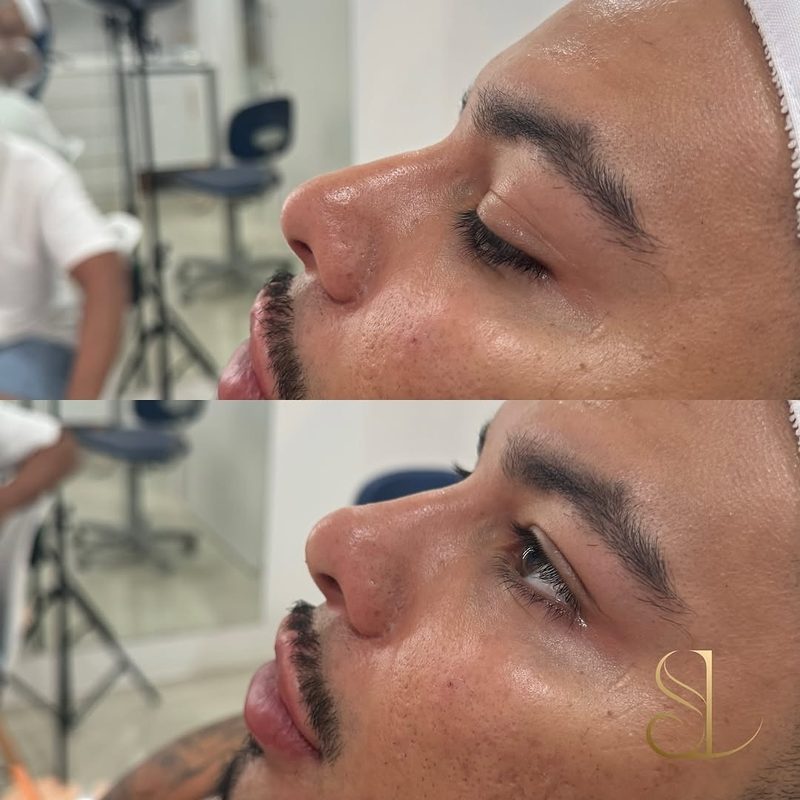 Resultado de harmonização facial de uma paciente