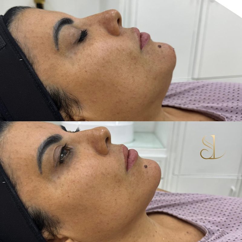 Resultado de harmonização facial de uma paciente