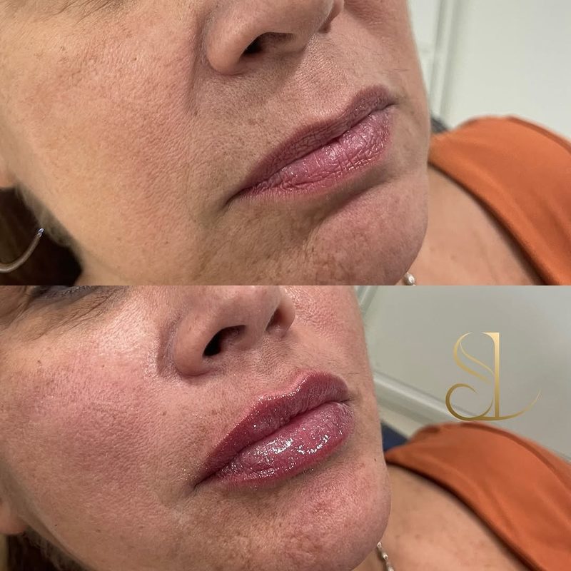Resultado de harmonização facial de uma paciente